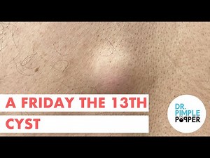 A Friday the 13th Cyst