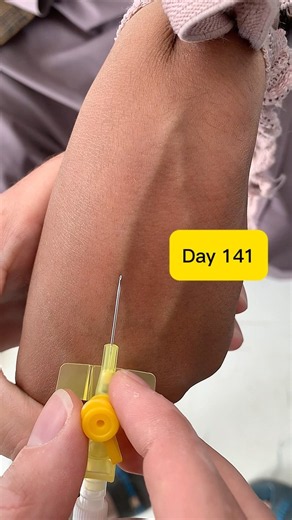 Day 141: 24G Cannula Insertion in Dorsal Hand Vein 💉 #Shorts#viralvideo #viralshorts #safai#safi