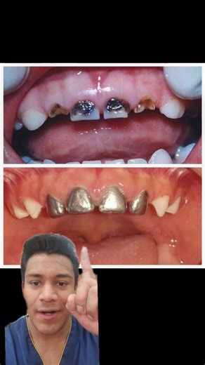 Coronas Dentales de Acero para Niños: Cuidados Esenciales
