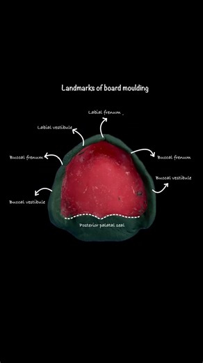 Anatomical landmark of edentulous secondary impression#edentulous#secondaryimpression#prosthodontic