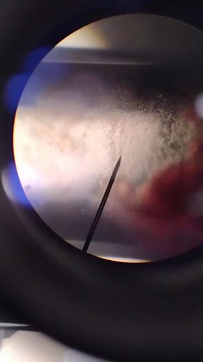 Understanding Microfilaria Under the Microscope