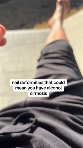 Scott Freda on Instagram: "Alcohol awareness, and education on social media please talk to your doctor. If you have concerns I’m an alcohol cirrhosis survivor at 47 AI Overview Several specific nail deformities and color changes can indicate alcoholic cirrhosis, often resulting from the liver’s reduced ability to produce proteins (like albumin), changes in hormone metabolism, or altered blood flow. Terry’s Nails (Most Common): The nails appear mostly white or “ground glass” in appearance, with a