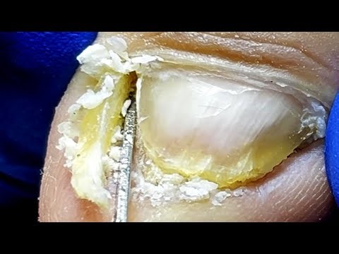 Extra Large Ingrown Toenails, Gently Pulled Out【Xue Yidao】
