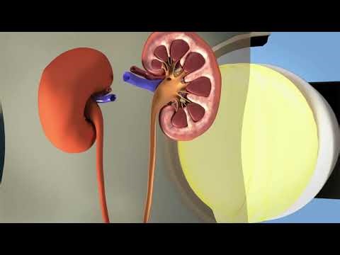 Shockwave Lithotripsy: Non-Invasive Treatment for Kidney Stones