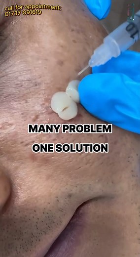 PRF, Subseccion, micro needling, LED light 🥰 #prf #subcession #microneedlingtreatment #ledlightingsolutions | Dr. Israt Jahan