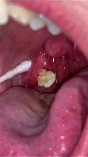 Effective Ways to Remove Tonsil Stones