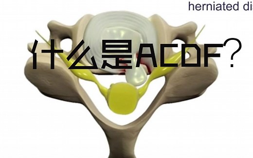 【搬运】颈椎前路融合手术（ACDF）的简介（Depuy）