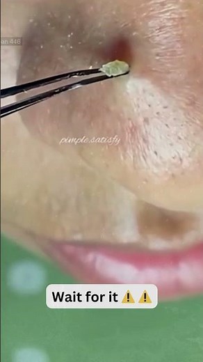 Deep Blackheads, Milia & Whitehead Removal pimple popping New| Big Cystic Acne Extraction #1171 2026