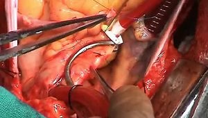 Myocardial Revascularization CABG