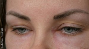 Young girl with an allergic reaction on the face and eyes, Quincke's edema. Swelling of the face from nose to eyes in a young woman. Angioedema close up view