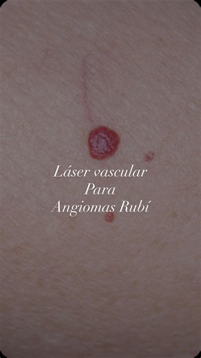 OnDerm Dermatología Monterrey on Instagram: "¿Tienes puntitos rojos en la piel y no sabes qué son? Los angiomas rubí pueden tratarse de forma segura con láser dermatológico, siempre después de una valoración médica. 🩺 Agenda tu consulta de valoración en OnDerm y cuida tu piel con especialistas. 💬 https://wa.me/5218181814704 📱WhatsApp (🇲🇽+52)8181814704 📞Tel. 81 8333 2414 y 81 2557 7004 🏥Torre Ixco Av. Lazaro Cárdenas 1010, planta baja local 8. Col. Residencial San Agustín, San Pedro Garza 