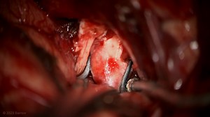 #219: Pterional Craniotomy with Anterior Clinoidectomy for Clipping of an Internal Carotid Artery Cave Aneurysm and Resection of a Pituitary Adenoma - Aneurysm - Seven Series Collection