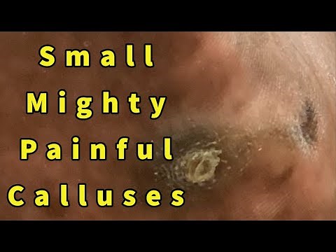 Small Mighty Painful Calluses: Intractable Plantar Keratoses Removal - Repost