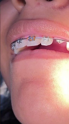 Impacted Canine Braces Treatment - 13 Months of Orthodontic Traction - Tooth Time Family Dentistry