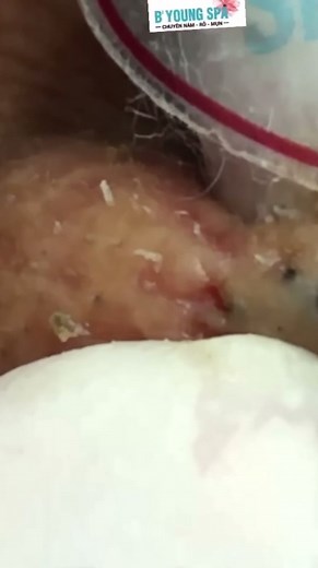 #blackheads #blackheadremoval #extraction #satisfying #foryoupage