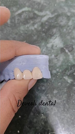 zirconia interior upper bridge #dental #zirconia #zirconiacrown #dentist