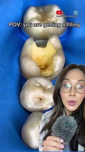 Dentistry Explained Episode 27 | This is 3 surface filling. The more surfaces, the higher the price. Measures need to be taken by a dentist so the tooth doesn’t accidentally bond to the other tooth. This is for a white filling but the same would be done for a silver filling creatir credit: @Dr. Diler Cruz #fillings #bonding #rootcanal