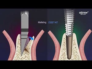 Ridge Split Surgery Tools-ESSET Kit