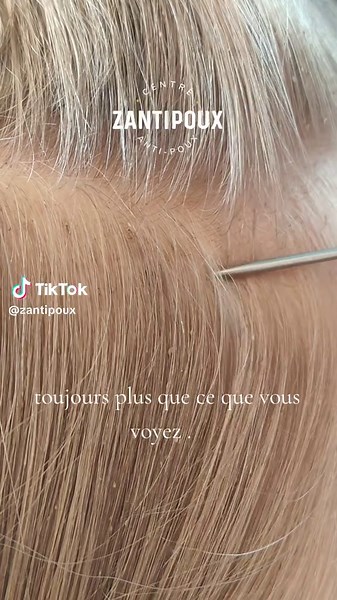 Le véritable combat contre les poux