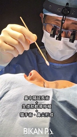 拘縮鼻の当日のビフォアフ#BIKAN整形外科 #BIKAN CLINIC #鼻翼縮小 #鼻整形 #鼻中隔延長 #団子鼻 #渡韓整形 #鼻尖形成 #整形レポ #鼻整形ダウンタイム #鼻フル #小鼻縮小