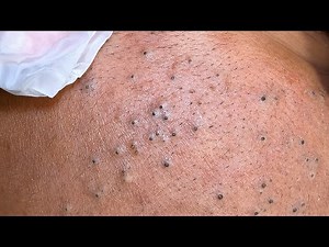 [ASMR] Satisfying Blackheads Removal Deep Pore Cleansing skincare routine