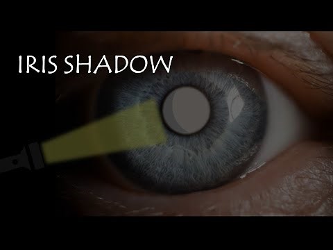 CONCEPT OF IRIS SHADOW | Immature vs Mature cataract