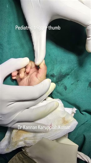 Surgical release of congenital trigger thumb