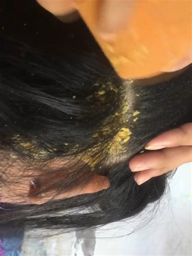 14K views · 87 reactions | Dandruff clean brings pure peace. | The Flake Doctor | Facebook