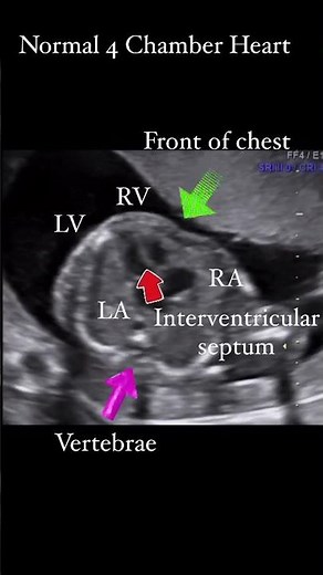 Shone complex or syndrome is a rare heart disease characterized by coarctationnof the aorta (not