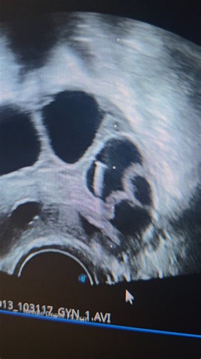 Dr karthika | Fertility expert on Instagram: "Pregnancy isn’t easy for everyone.....👨‍👩‍👧 Even in the best of circumstances, there’s only about a 20% chance of conceiving each month📆!! So many tiny steps ☸️have to fall perfectly in place like egg release, sperm meeting egg, fertilization, implantation ..... and anything can falter along the way❗️ For some couples, the natural path ❌️doesn’t work, and they need medical help like IUI & IVF...😇 These assisted reproductive techniques need count