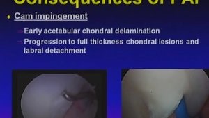 History, Anatomy, and Indications For Hip Arthroscopy