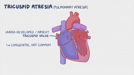 Video: Tricuspid atresia: Nursing - Video Explanation! | Osmosis | Osmosis