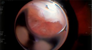 Retina Live | Eyetube