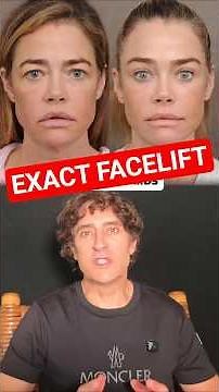 Denise Richards Exact Facelift