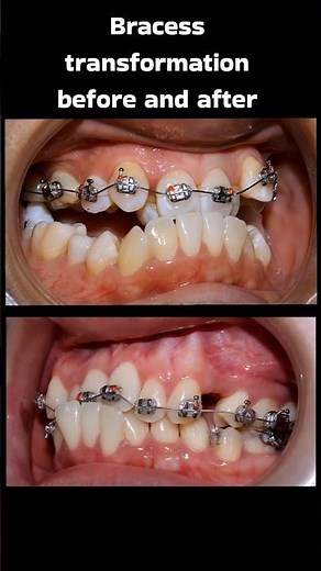 crossbite correction #trendingshorts #shortvideo #viralvideo #orthodontist #shorts #viralvideo