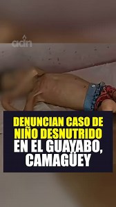 Denuncian caso de niño desnutrido en El Guayabo, Camagüey. El menor presenta desnutrición severa y requiere atención médica especializada, agrega el informe. | ADN Cuba