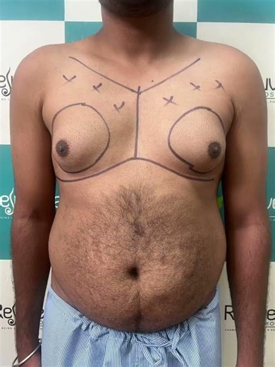 Gynecomastia Surgery Before & After | Male Breast Reduction Transformation | Dr. Ratnesh Jenaw