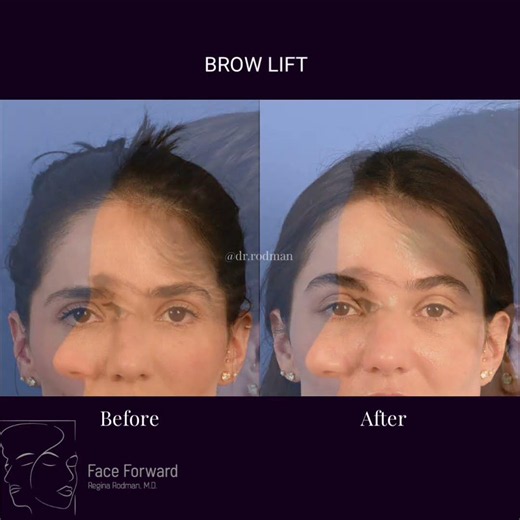 Brow Lift Results| Natural Results| Facial Plastic Surgery