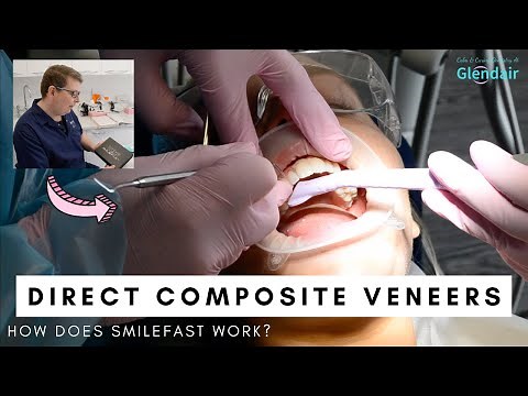 Direct Composite Veneers Procedure | Dentist Matt Explains SmileFast!