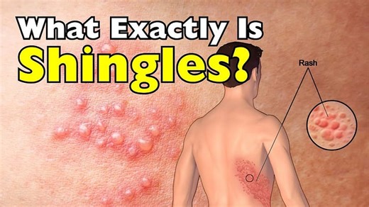 What Exactly Is Shingles? Is It Contagious?
