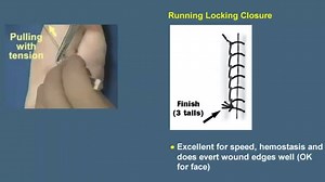 Running Lock Closure. Suture Techniques (Essential Surgical Skills) (Dr. Prodigious 2.0) https://www.youtube.com/watch?v=bJsR9etkob4 | Clinical Anatomy & Operative Surgery