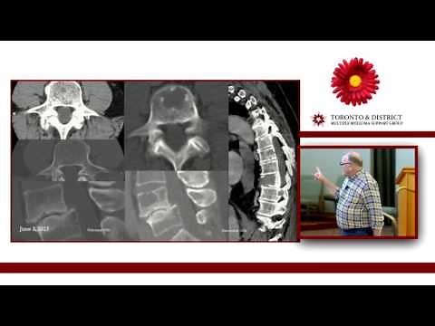 Kyphoplasty (Vertebral Augmentation) for Myeloma: The Cement Facts - Is It Worth It?