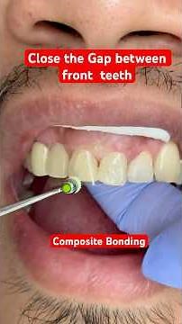 Close the Gap between front teeth