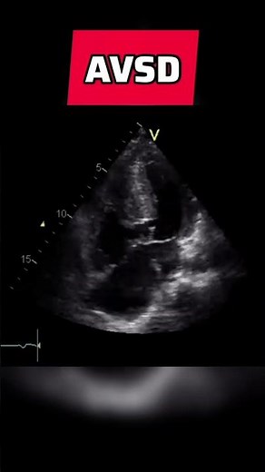Atrioventricular septal defect - congenital heart defect #echocardiography #AVSD
