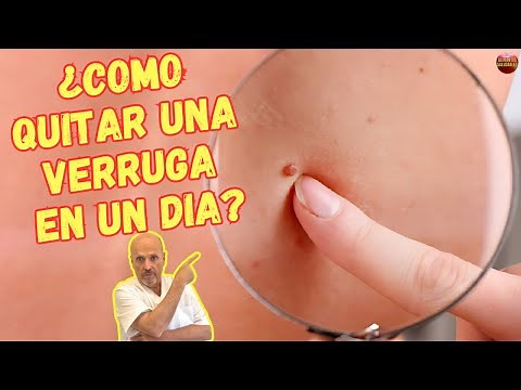 ✅ How to remove a wart in one day? ✅