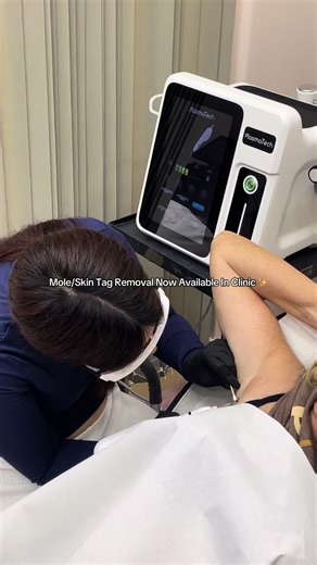 Mole & skin tag removal now available in clinic ✨ Fast, safe, and effective treatments with minimal downtime. Regain confidence in your skin — book your free consultation today. #fyp #moleremovaltreatment #skintag #treatment #viral