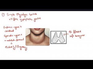 Simple Goitre | Thyroid