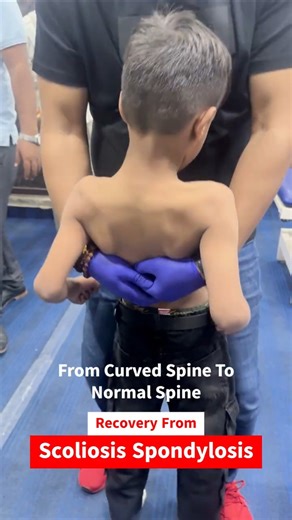 Scoliosis & Spondylitis Recovery Without Surgery? 😱 | Chiropractic Miracle by Dr. Rajneesh Kant