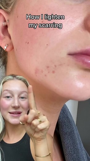 Glow Hub Scar Slayer Serum: Your Skincare Hero for Fading Scars