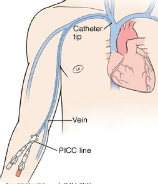 PICC dressing - statlock